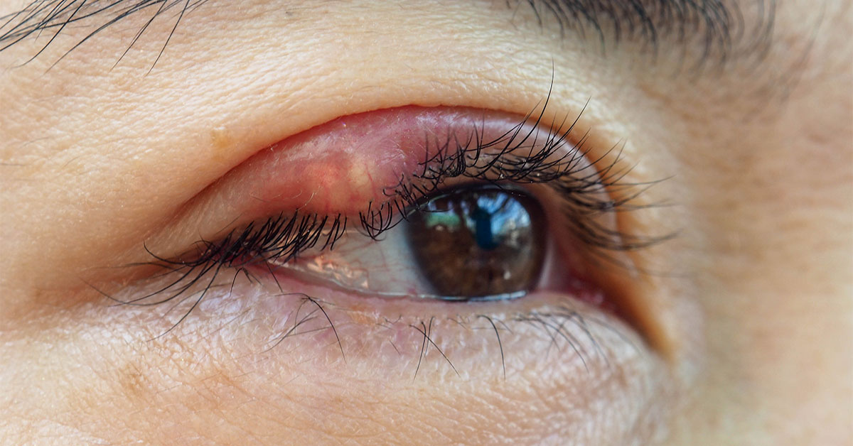 Jačmeň na oku – prečo vzniká a ako ho liečiť