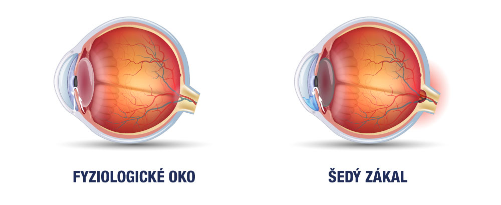Naľavo zdravé oko a napravo oko so šedým zákalom. Postupné zahmlievanie šošovky vám môže výrazne skomplikovať bežný život a postupne vás môže pripraviť aj o zrak.