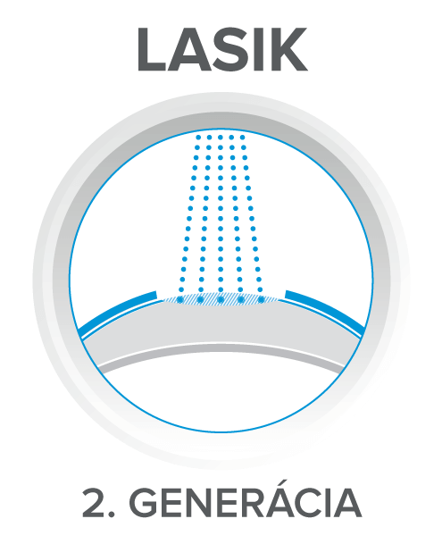 Z-Lasik operácia očí