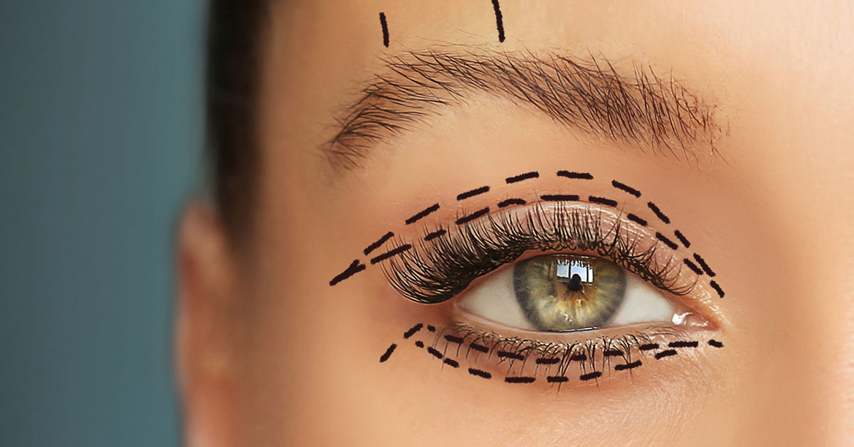 Ovisnuté viečka bez klasického skalpela: prečo je laserová blefaroplastika šetrnejšia cesta