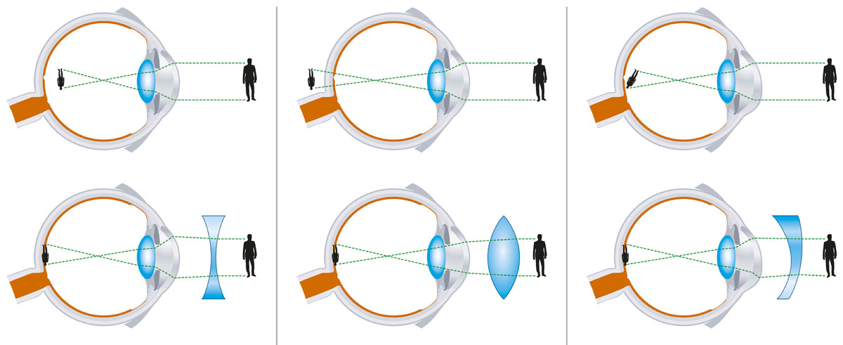 Rozdiel medzi krátkozrakosťou (myopia), ďalekozrakosťou (hyperopia) a astigmatizmom.