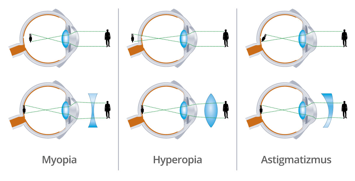 rozdiely krátkozrakosť, hyperopia, astigmatizmus
