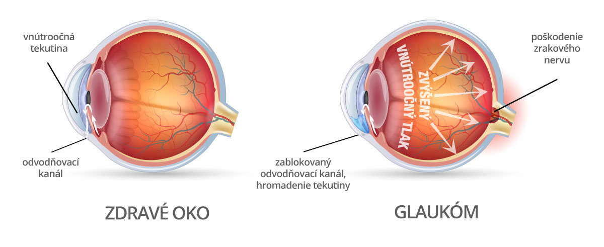 Príznaky zeleného očného zákalu